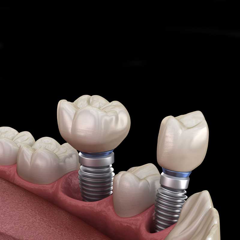 DENTAL IMPLANT in Dumas DENTAL IMPLANT in Dumas
