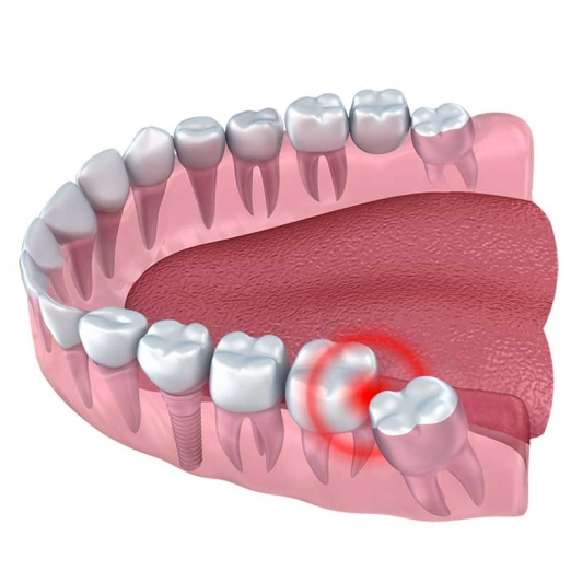 Wisdom Teeth Removal in Dumas