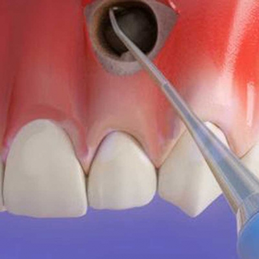 Root End Surgery in Dumas